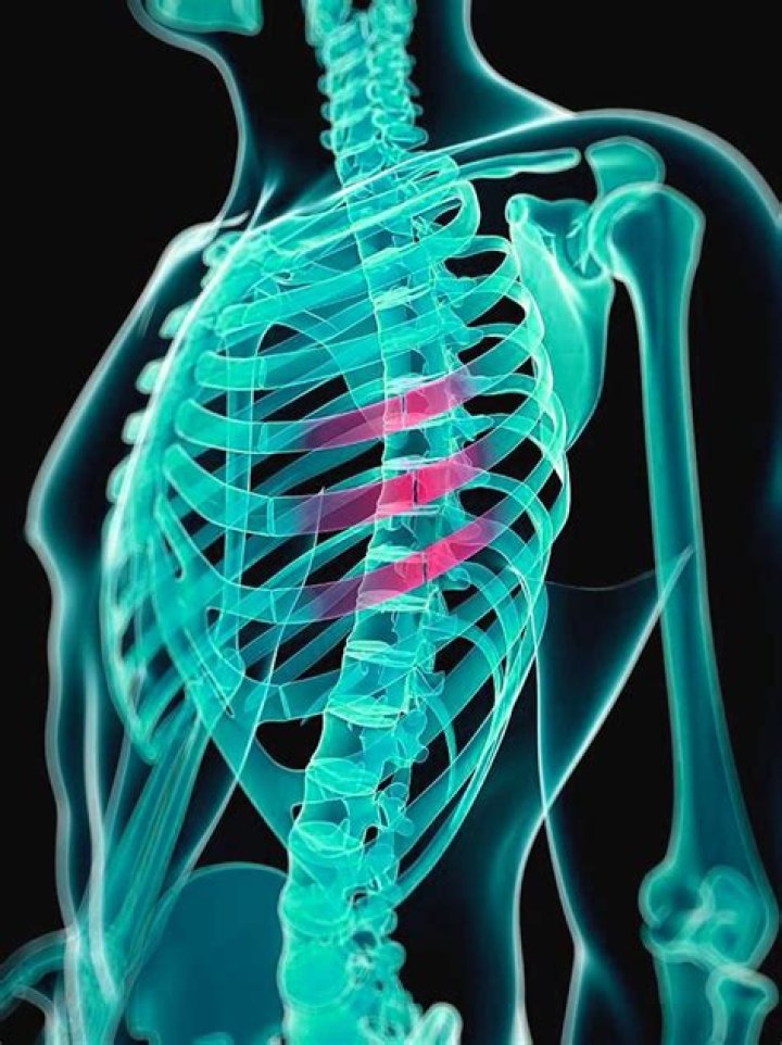 What can cause broken ribs?