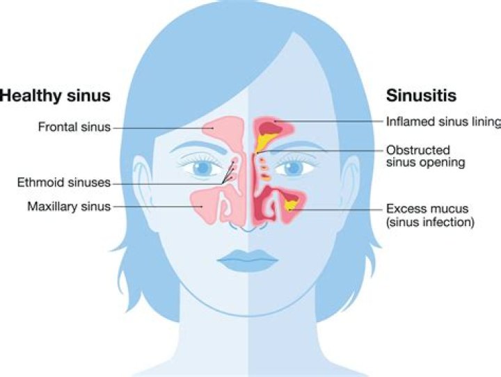 What can cause sinus tachycardia?