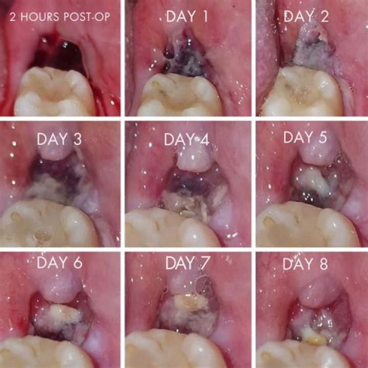 What can you eat day after tooth extraction?