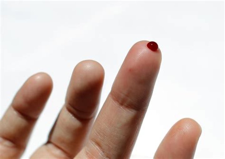 What causes blood clots in the hands?
