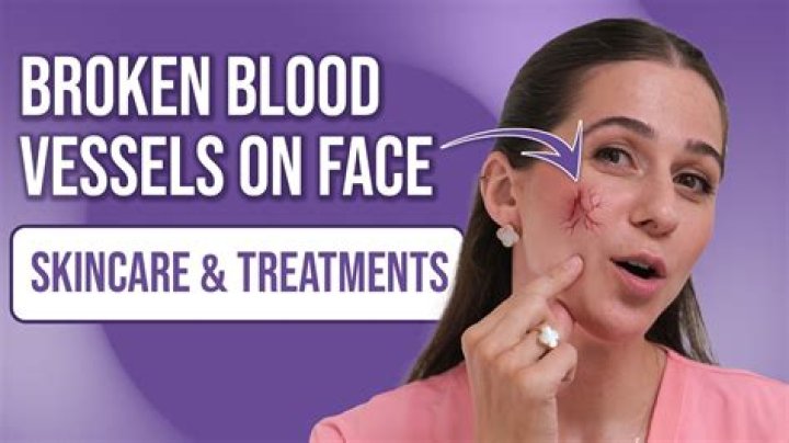 What causes broken blood vessels in baby's eyes?