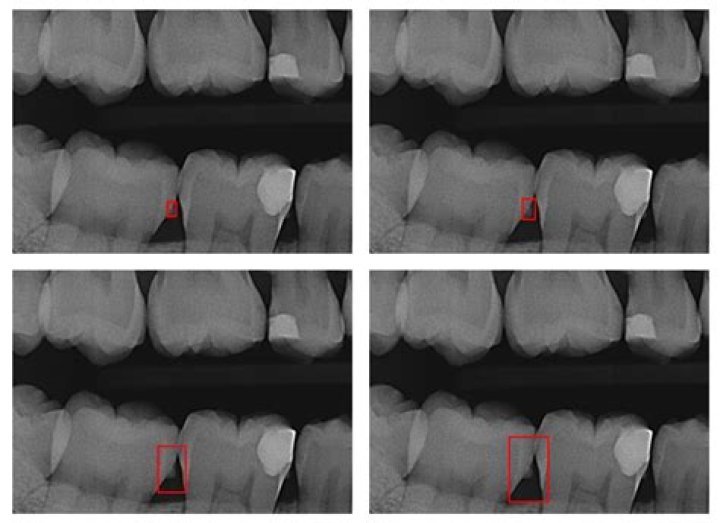 What causes burnished calculus? | ContextResponse.com