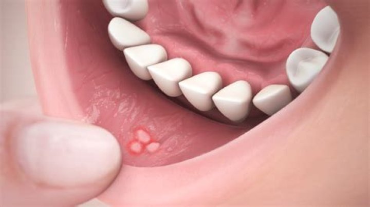 What causes canker sores on your gums?