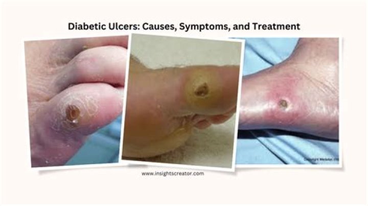 What causes diabetic ulcers?