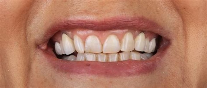What causes enamel to come off teeth?