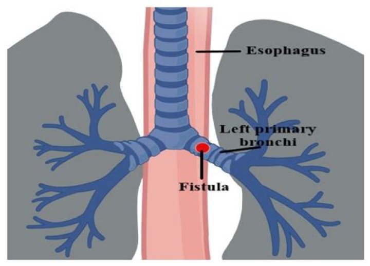 What causes inflamed bronchial tubes?