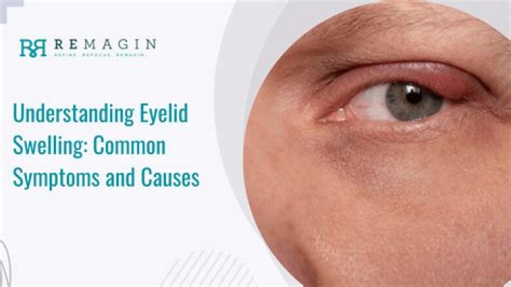 What causes lazy eyelid?