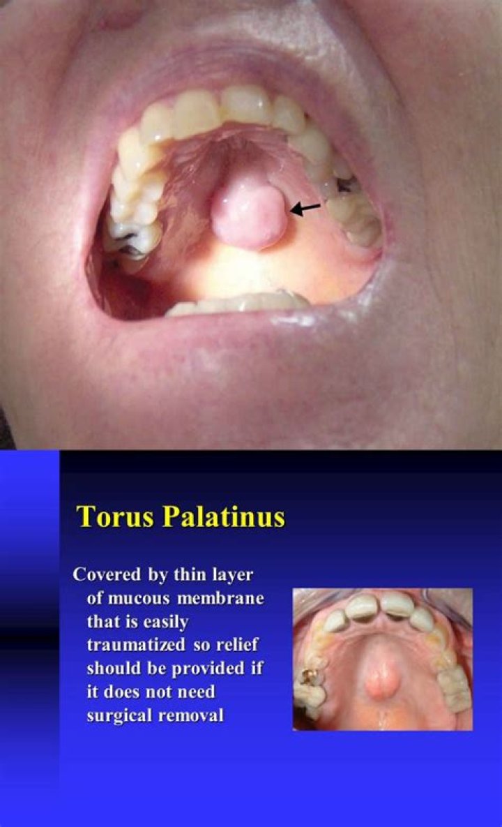 What causes mandibular torus? | ContextResponse.com
