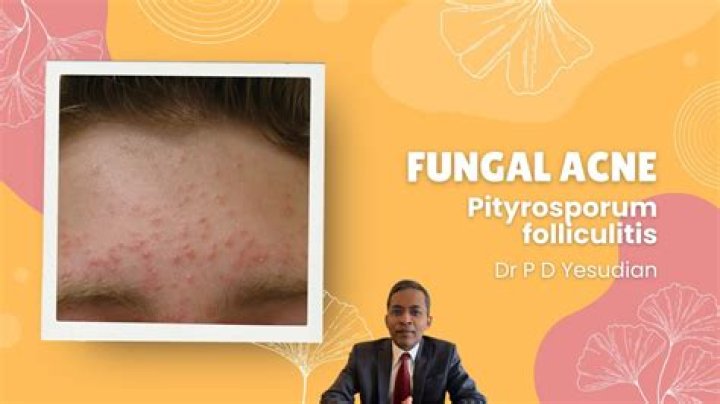 What causes pityrosporum ovale? | ContextResponse.com