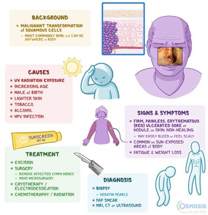 What causes squamous cell carcinoma?