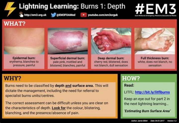 What degree are most electrical burns?