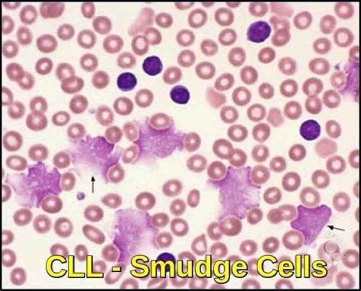 What do smudge cells indicate?