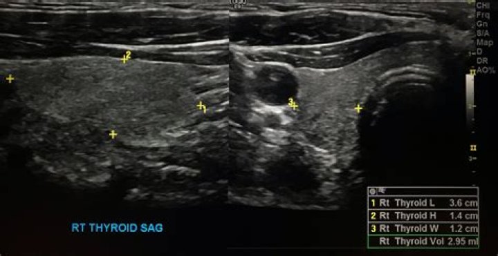 What do they look for in a thyroid ultrasound?