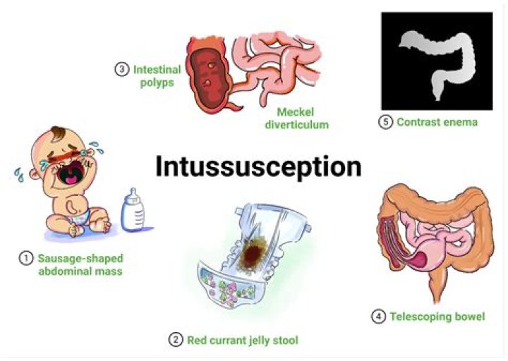 What do you do for intussusception?