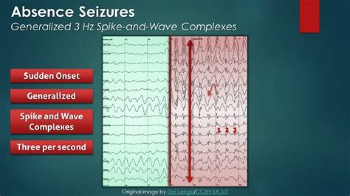 What does an absence seizure look like?