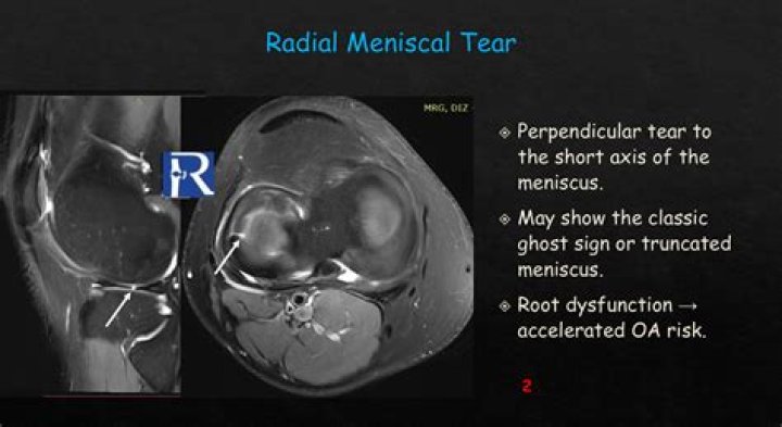 What does an MRI show in the back?
