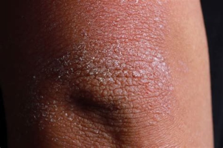 What does ashy skin mean?