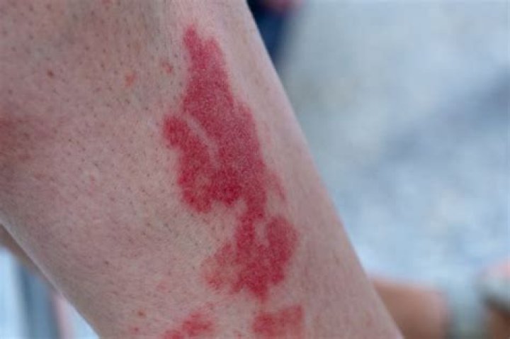What does Hikers rash look like?