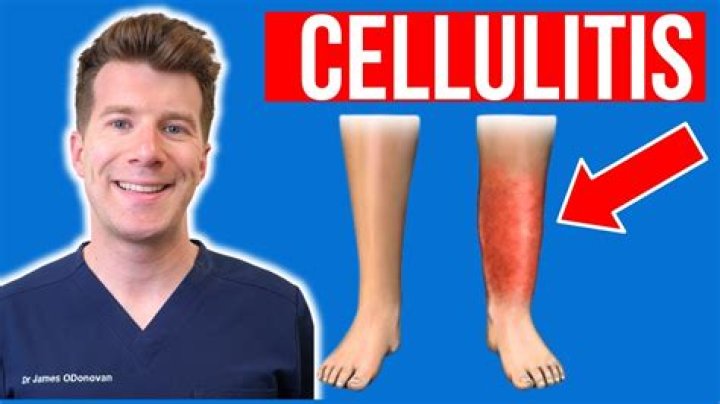 What does it mean when cellulitis itchy?
