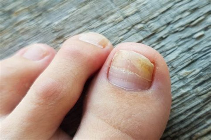 What does it mean when your toenail turns brown?