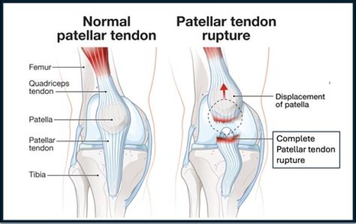 What does tendon mean in medical terms?