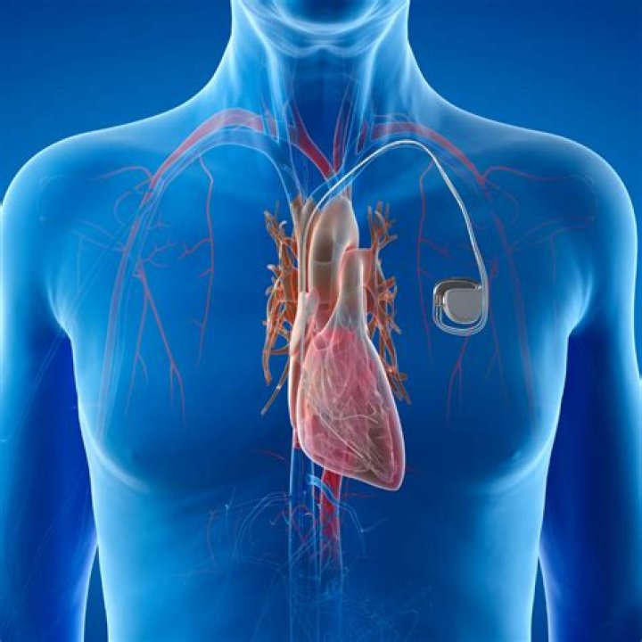 What happens if you have an MRI with a pacemaker?