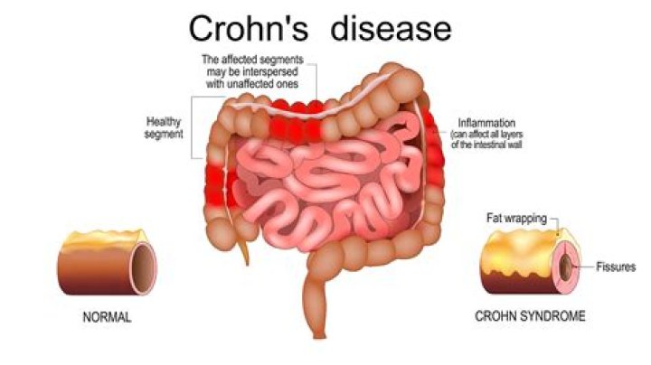What happens if you have Crohn's disease?