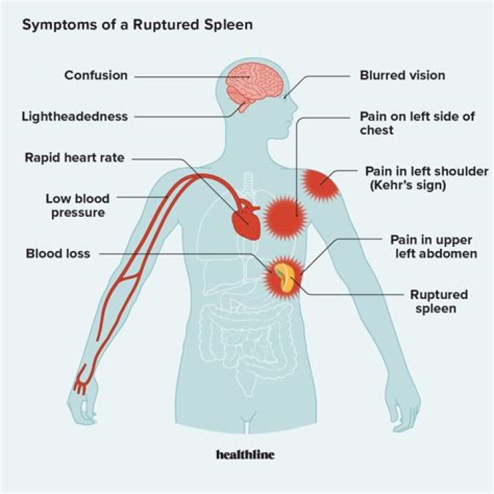 What happens if you rupture your spleen?