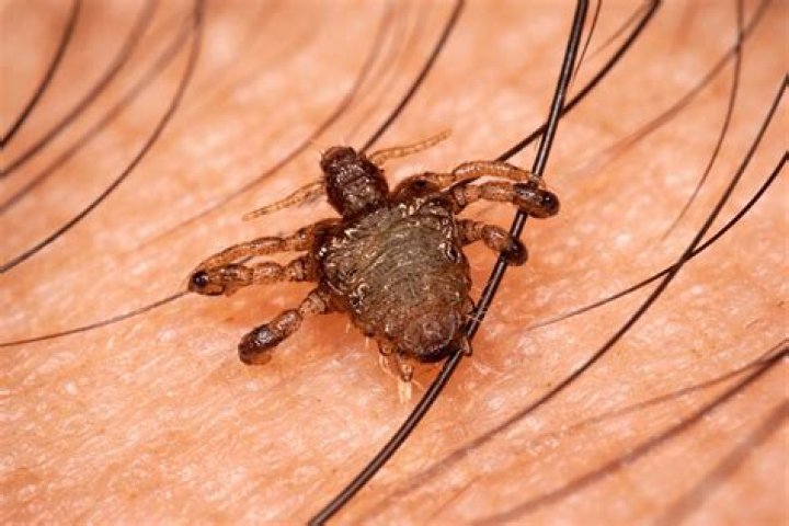 What home remedy gets rid of crabs?