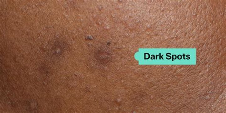 What ingredient fades age spots?