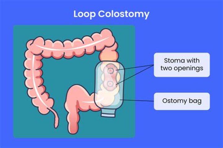 What is a diverting loop ileostomy?