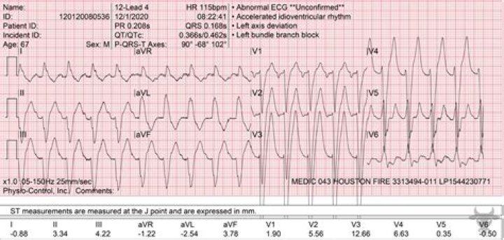 What is a first degree AV block on an ECG?