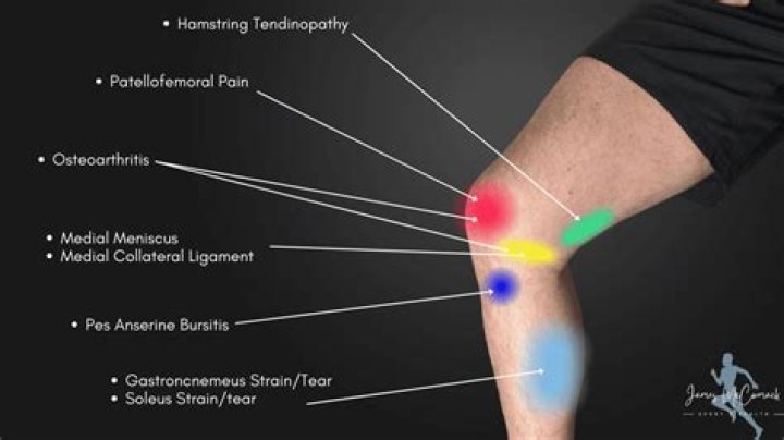 What is a knee strain?