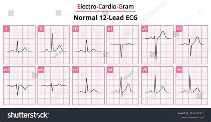 What is a normal heart rhythm?