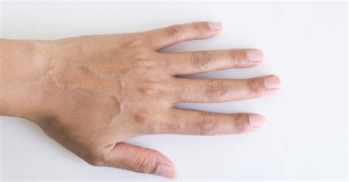 What is a rolling vein?