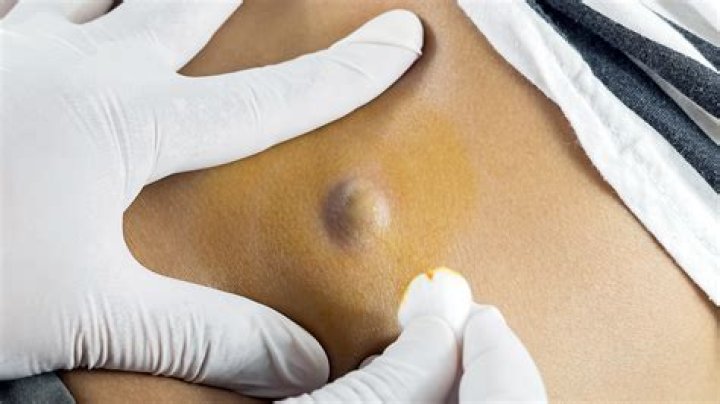 What is a sebaceous cyst filled with?
