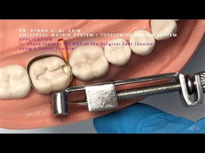 What is a tofflemire used for?