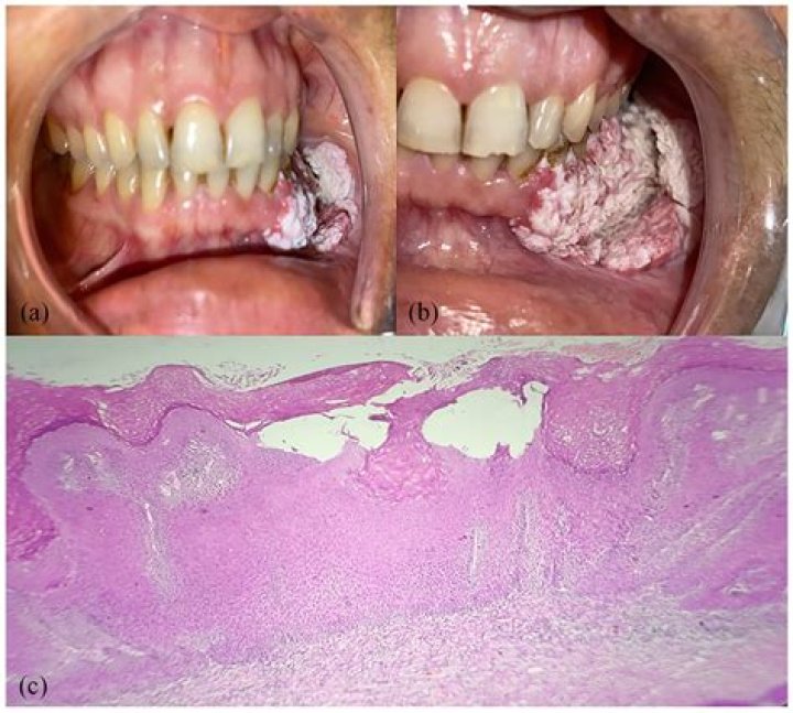 What is a Verrucous Acanthoma?