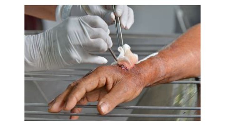 What is an occlusive blood clot?