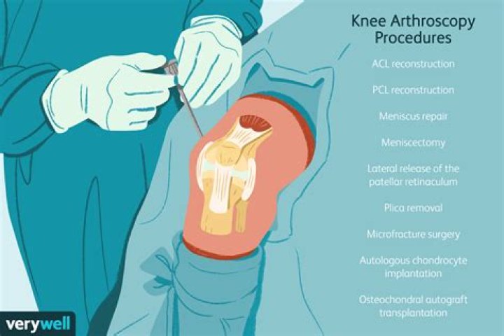 What is arthrotomy of the knee joint?