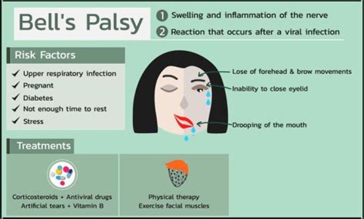 What is best treatment for Bell's palsy?