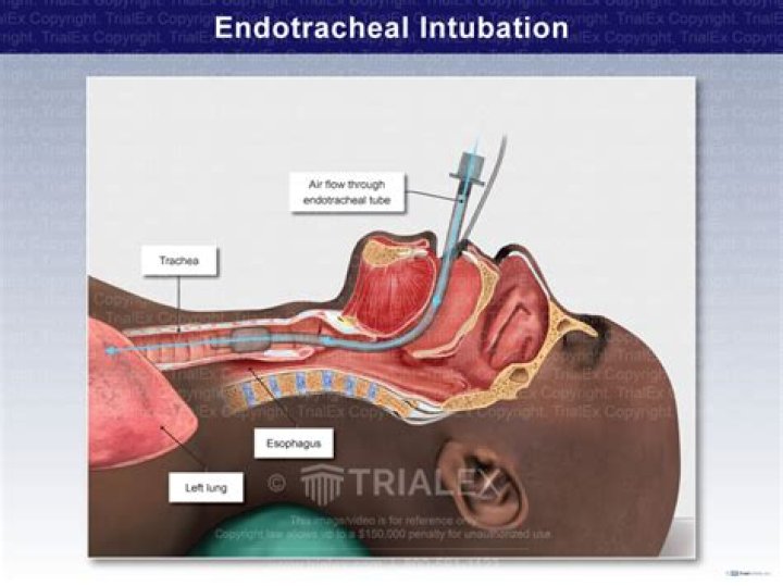 What is chest intubation? | ContextResponse.com
