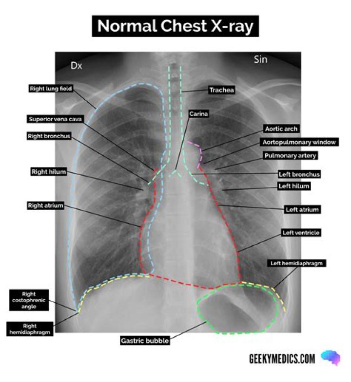 What is chest PA and LAT?