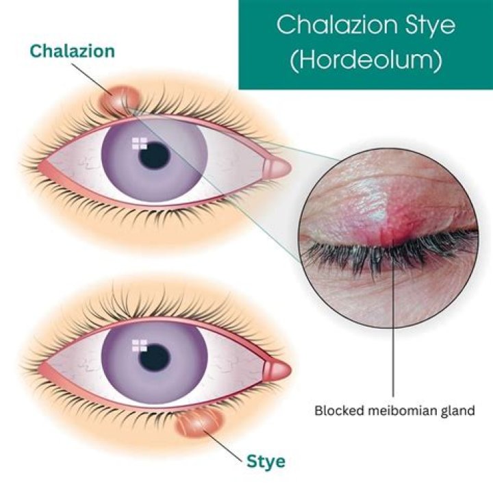 What is difference between stye and chalazion?