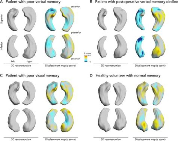 What is hippocampal atrophy?