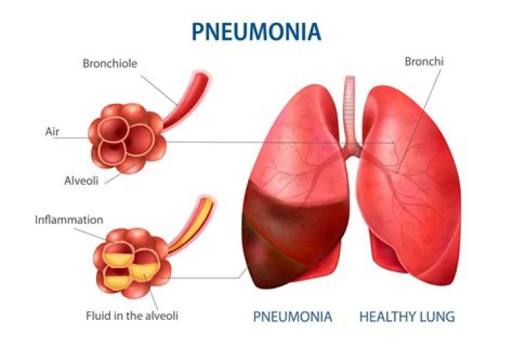 What is hypostatic pneumonia? | ContextResponse.com