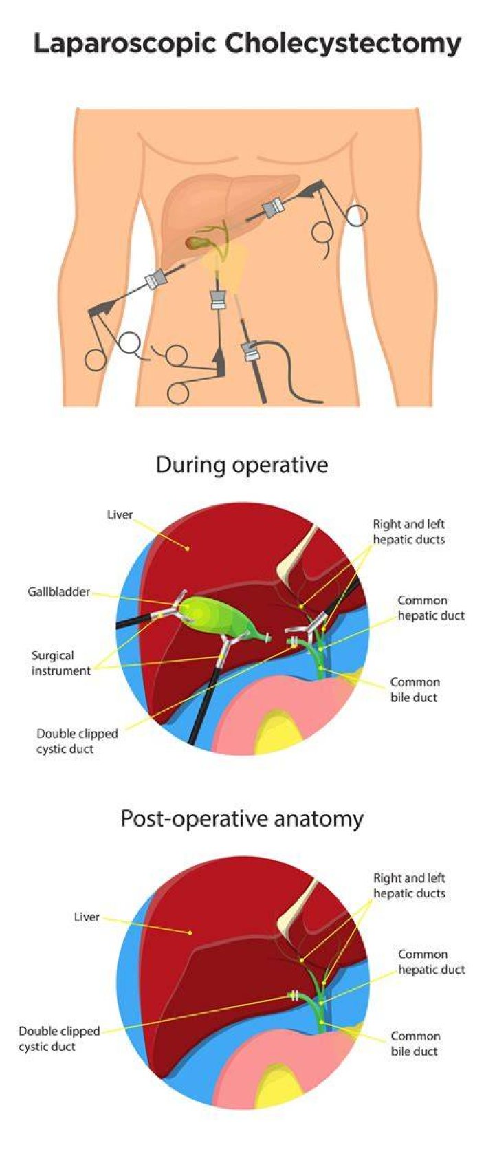 What is open cholecystectomy? | ContextResponse.com