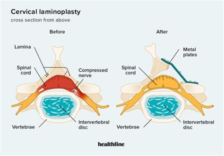 What is removal of spinal lamina?