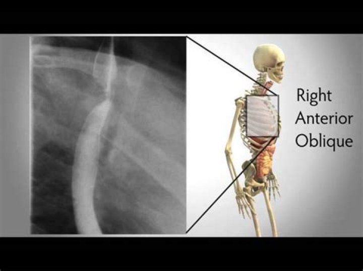 What is right anterior oblique position?