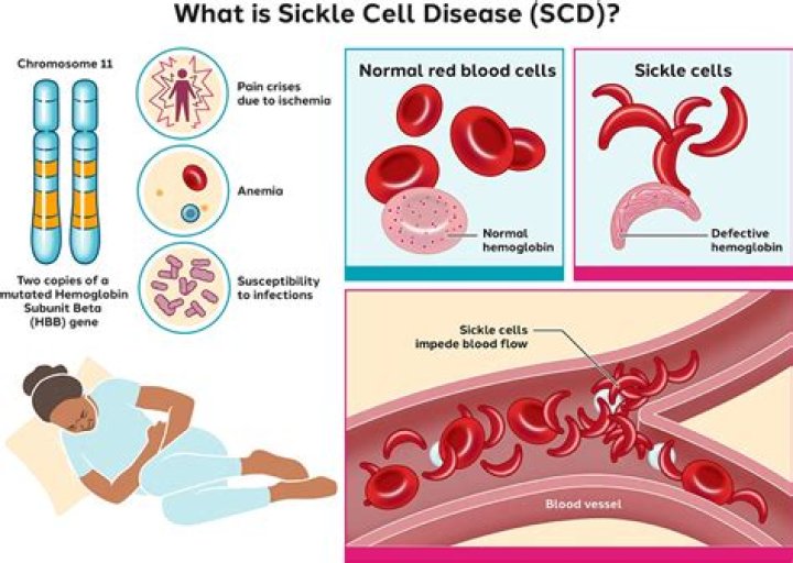 What is SCD lifestyle?